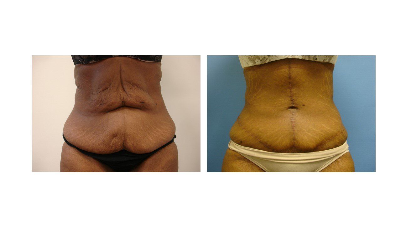 Two pictures of a woman 's stomach before and after surgery.