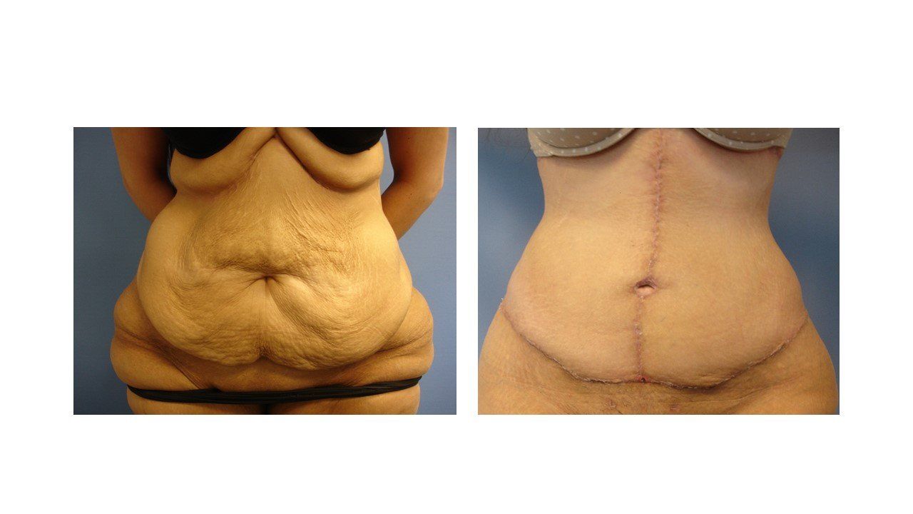A woman 's stomach is shown before and after surgery.