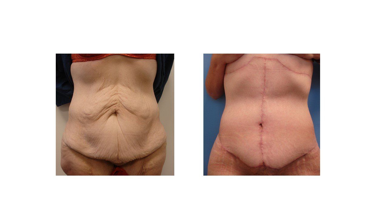 A woman 's stomach before and after surgery.