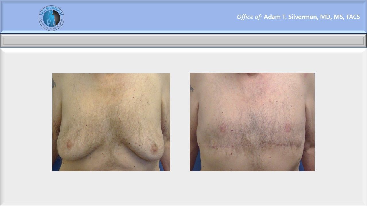 gynecomastia before and after