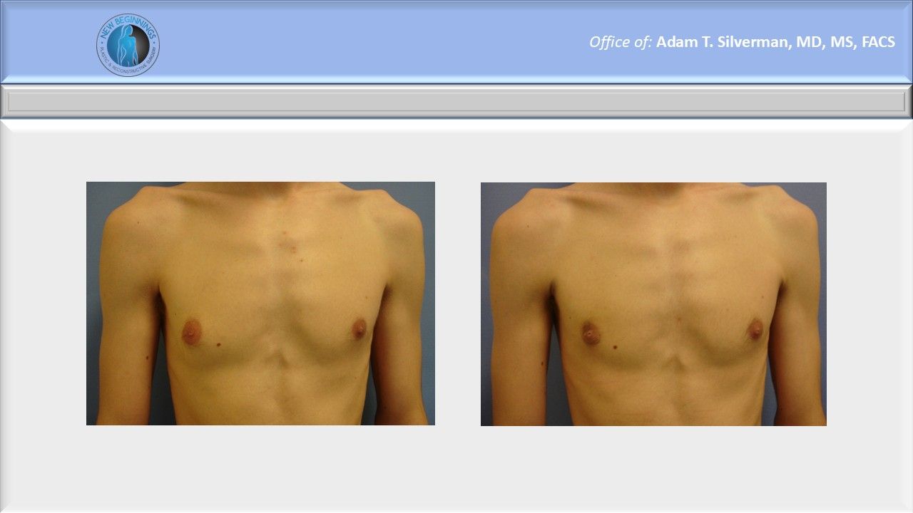 gynecomastia before and after