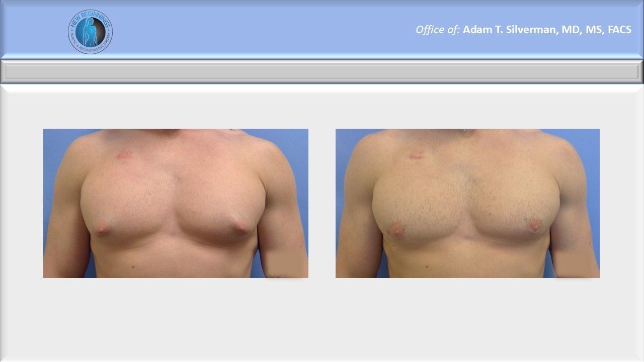 gynecomastia before and after
