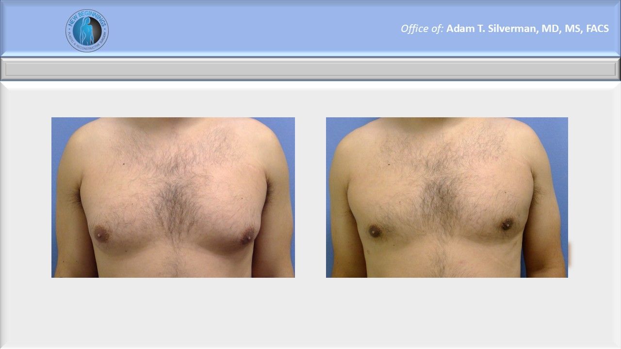 gynecomastia before and after