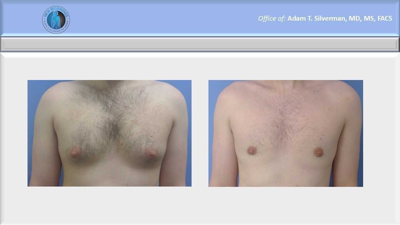 gynecomastia before and after