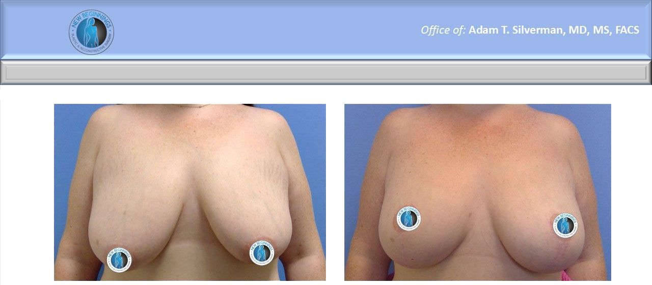Mastopexy