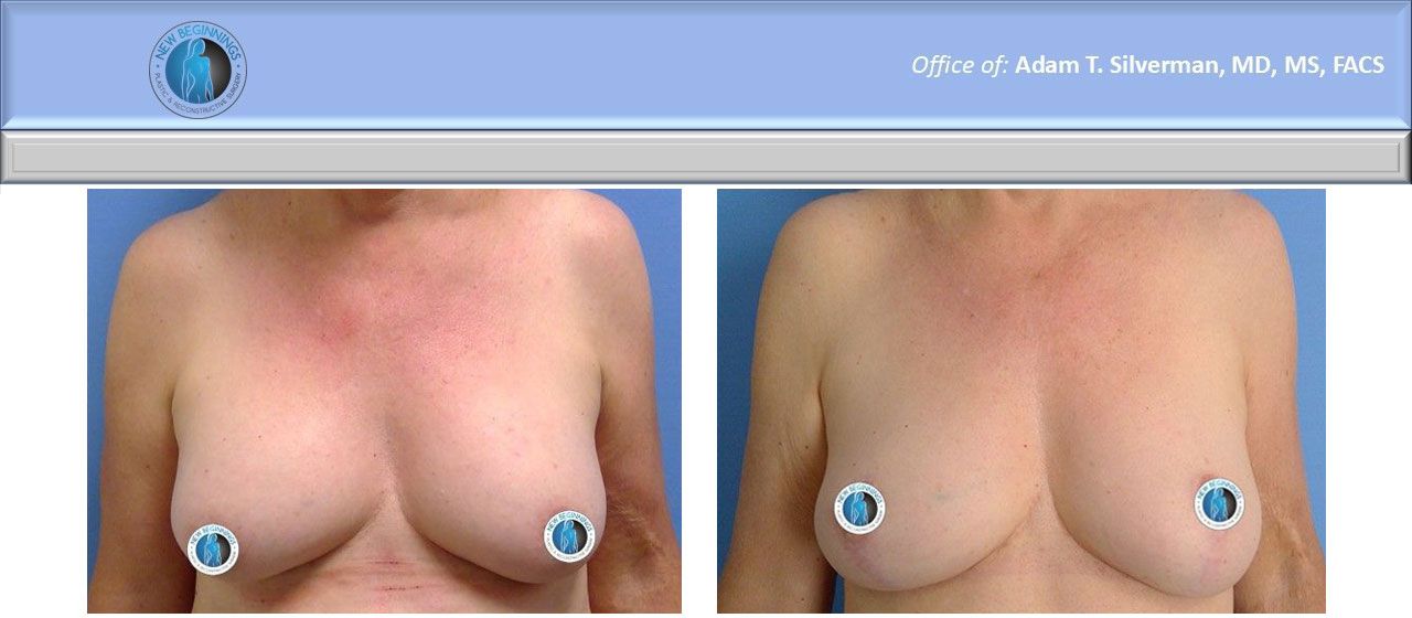 Mastopexy before and after