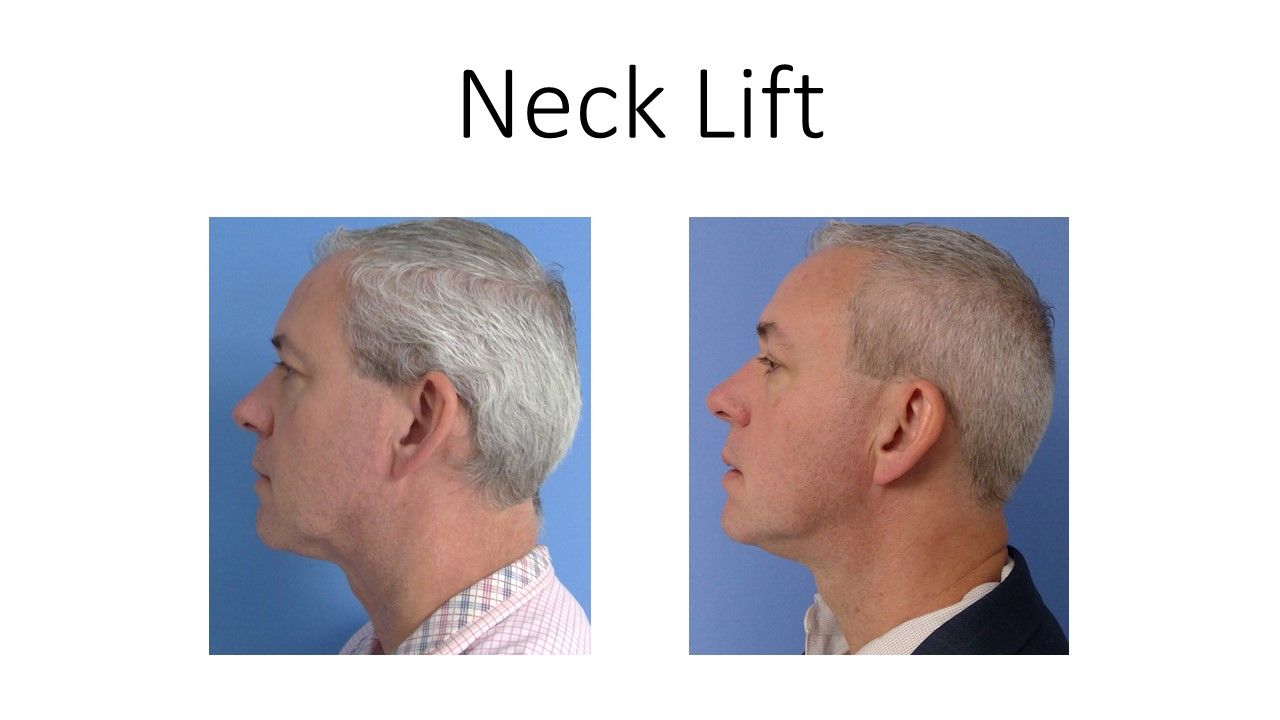 Two pictures of a man 's neck before and after a neck lift.