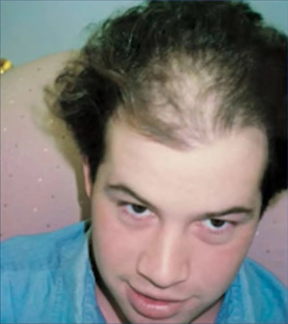 Hair restoration service