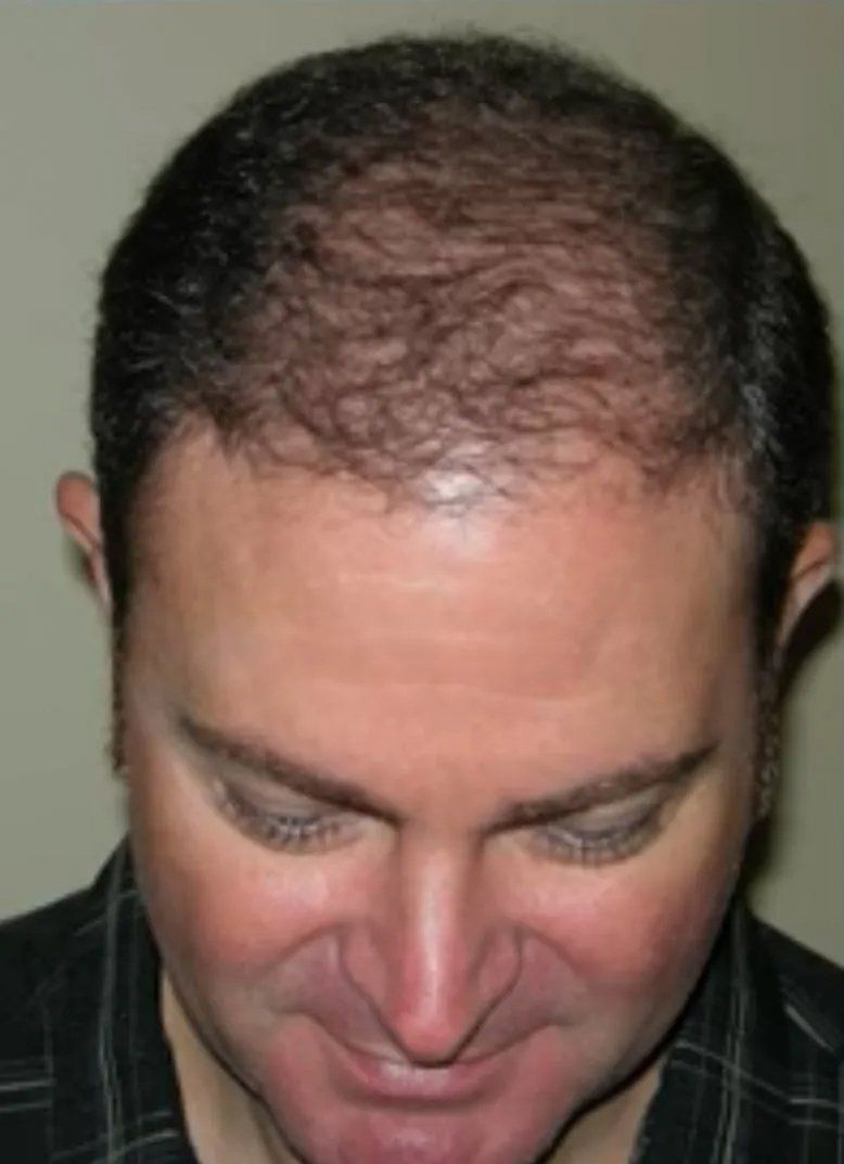 Hair restoration service