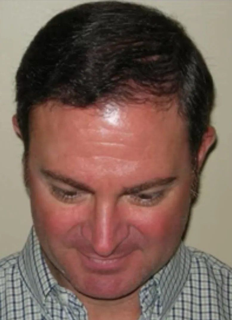 Hair restoration service