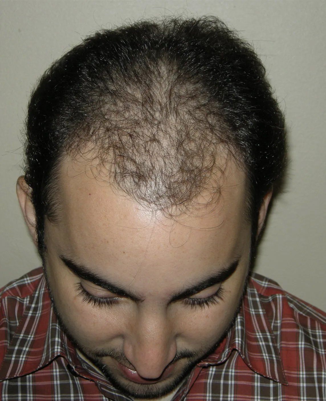 Hair restoration service