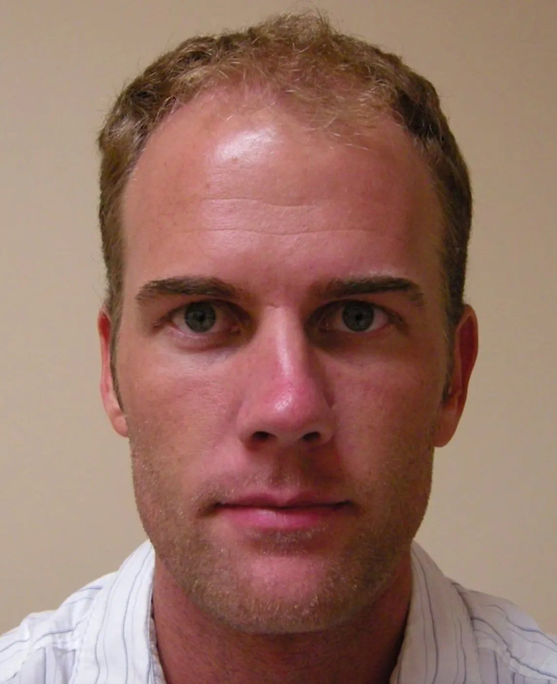 Hair restoration service