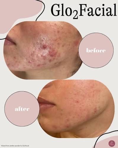 Before and after comparison of a Glo2Facial treatment showing reduction in facial acne and redness on a person's cheek.