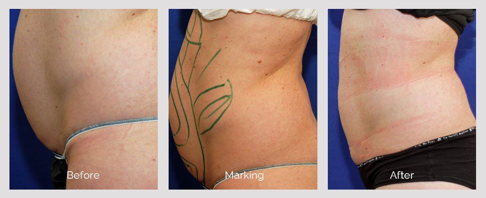 Nuface Laser And Vein Center liposuction before/after