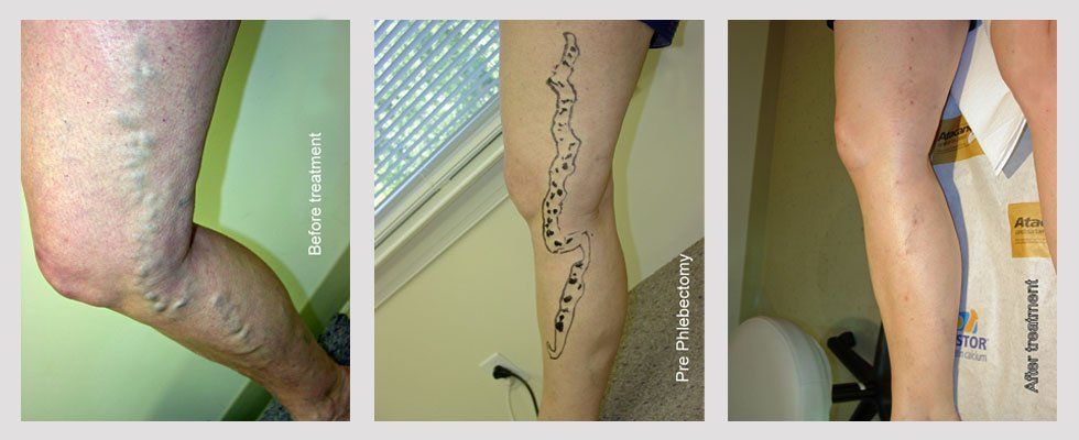 Nuface Laser And Vein Center varicose veins before/after