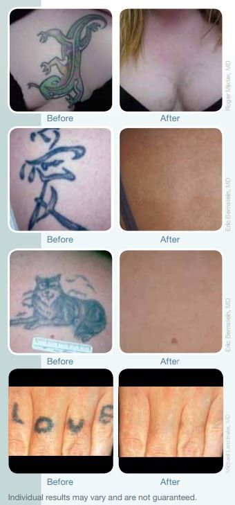 Before & After Tattoo Removal