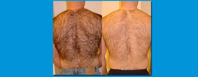 Laser Hair Removal Charleston Hurricane WV Permanent Hair Reduction