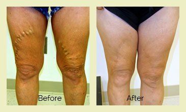 Before & After - Varicose Veins Treatment