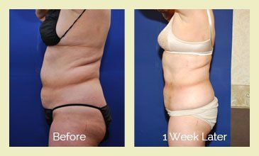 Before & After - Liposuction Surgery