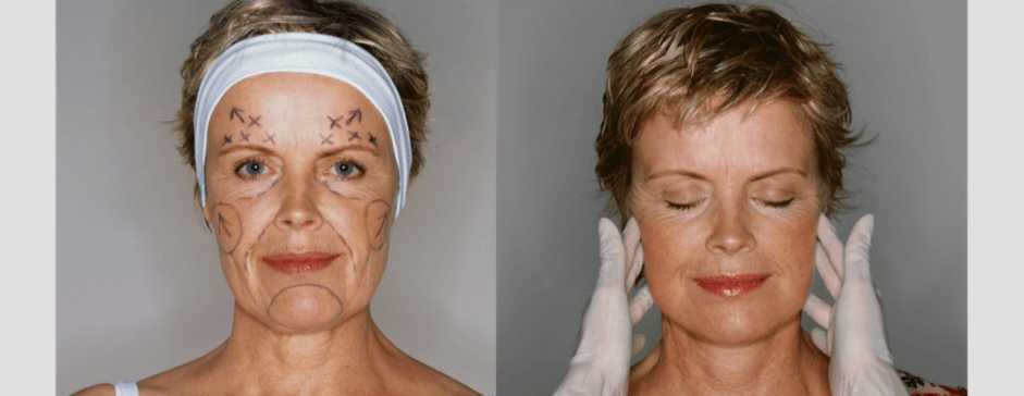 Before and After CO2 Laser Treatment Photos