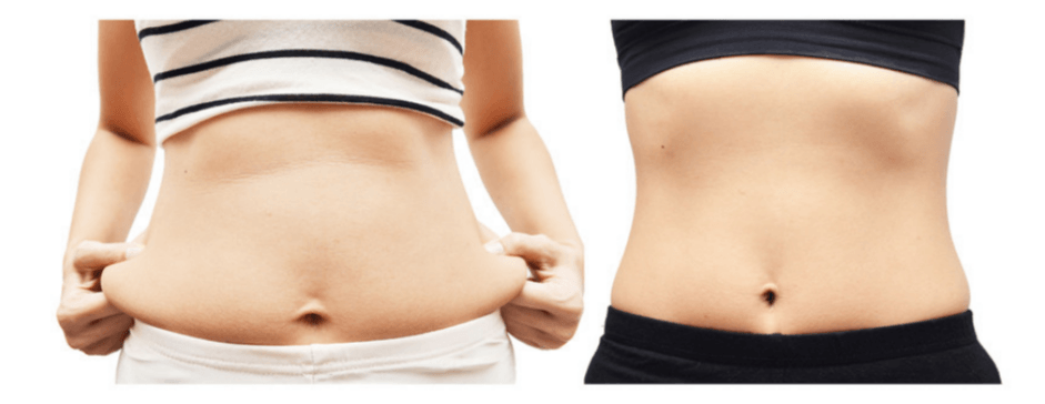 Before & After - Liposuction Surgery