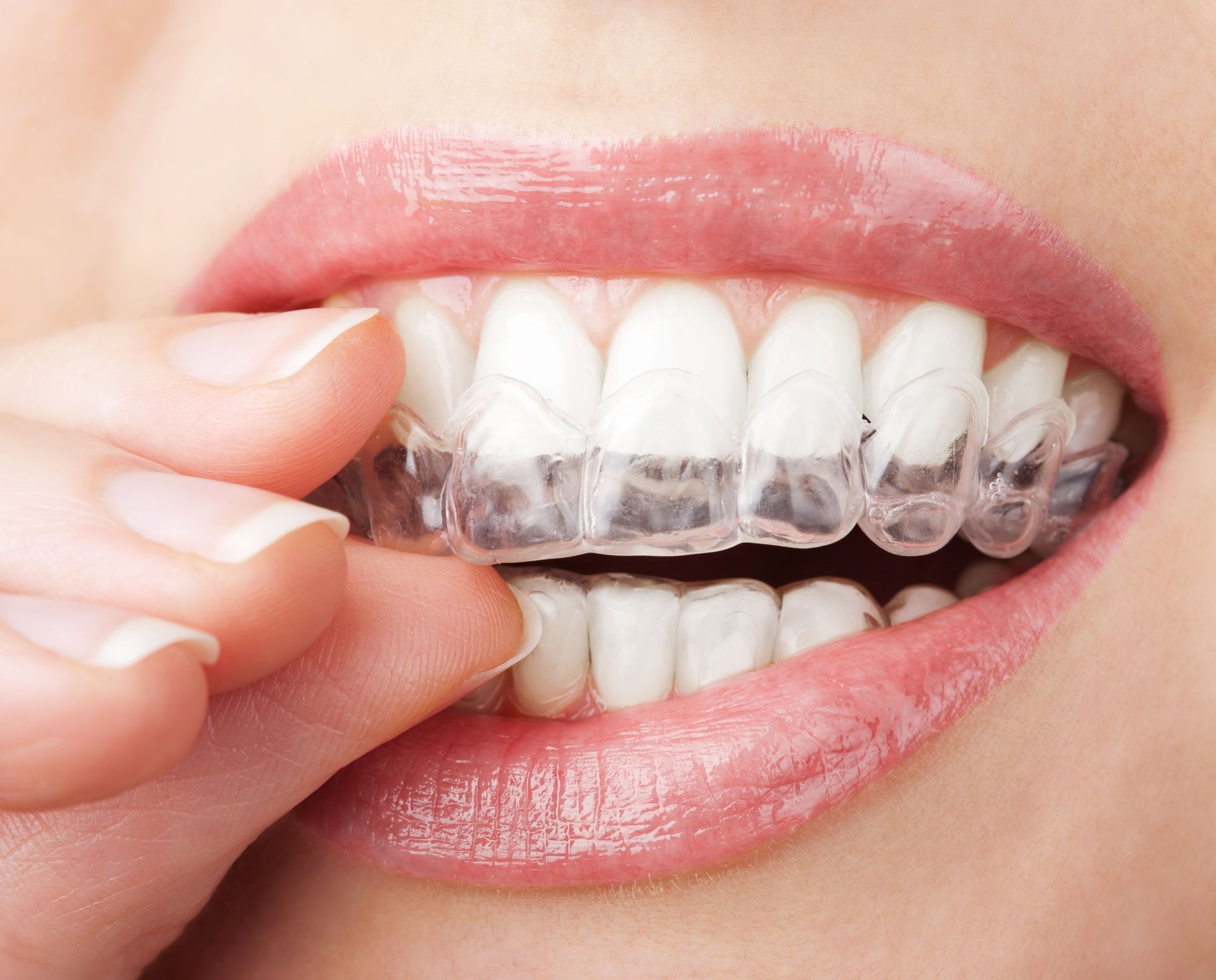 Close-up of a person placing a clear aligner tray over their teeth for orthodontic treatment.