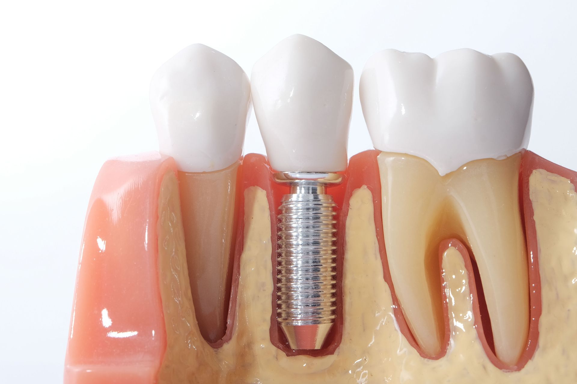 dental implant