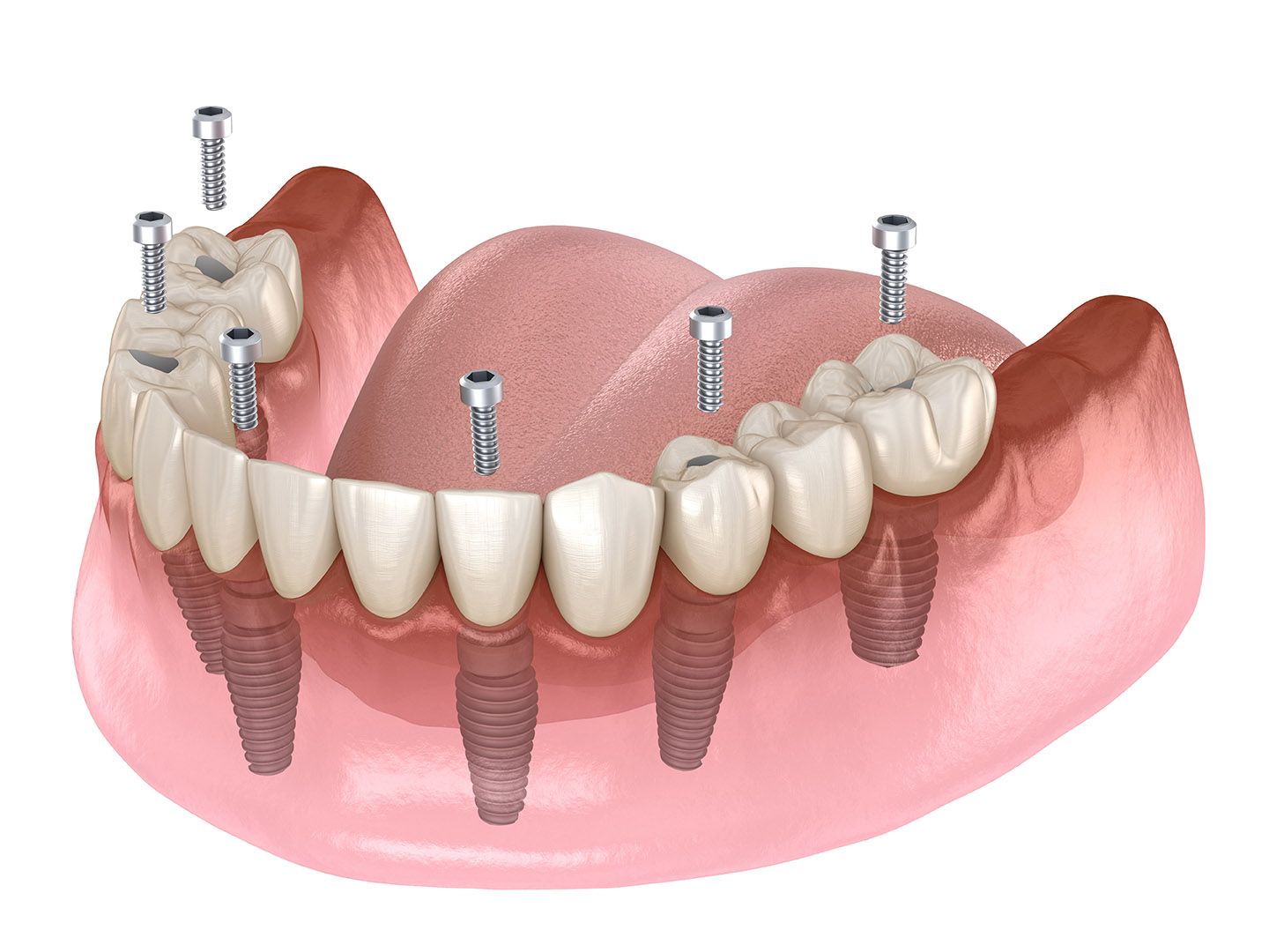 All-On-4 dental implants diagram