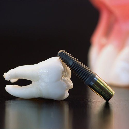 Dental implants