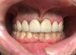 Close-up of a person's mouth showing upper and lower teeth. Upper teeth are white, lower teeth are yellowish.