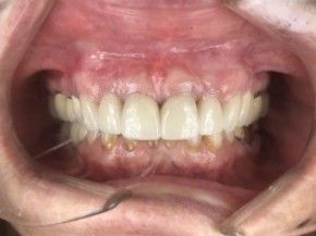 Open mouth showing upper and lower teeth, some teeth are capped, in a dental setting.