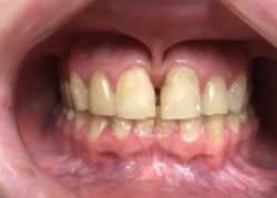 Open view of a mouth with yellowish teeth, a gap between the two front teeth, and pink gums.