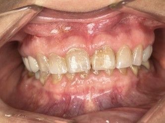 Close-up of a person's teeth. Yellowed teeth with visible plaque are centered, surrounded by pink gums.