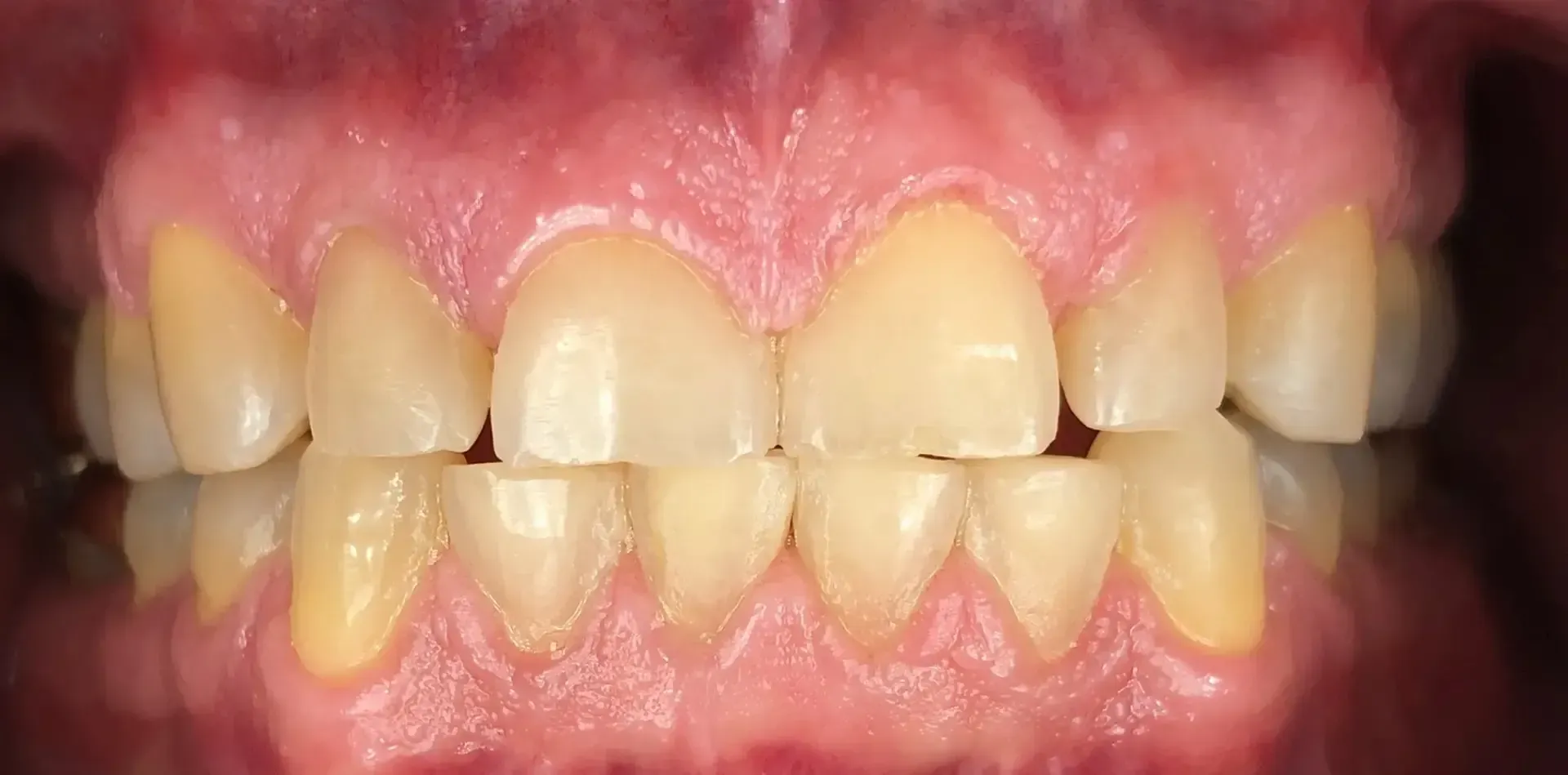 Close-up of teeth. Yellowish upper and lower teeth, with pink gums.