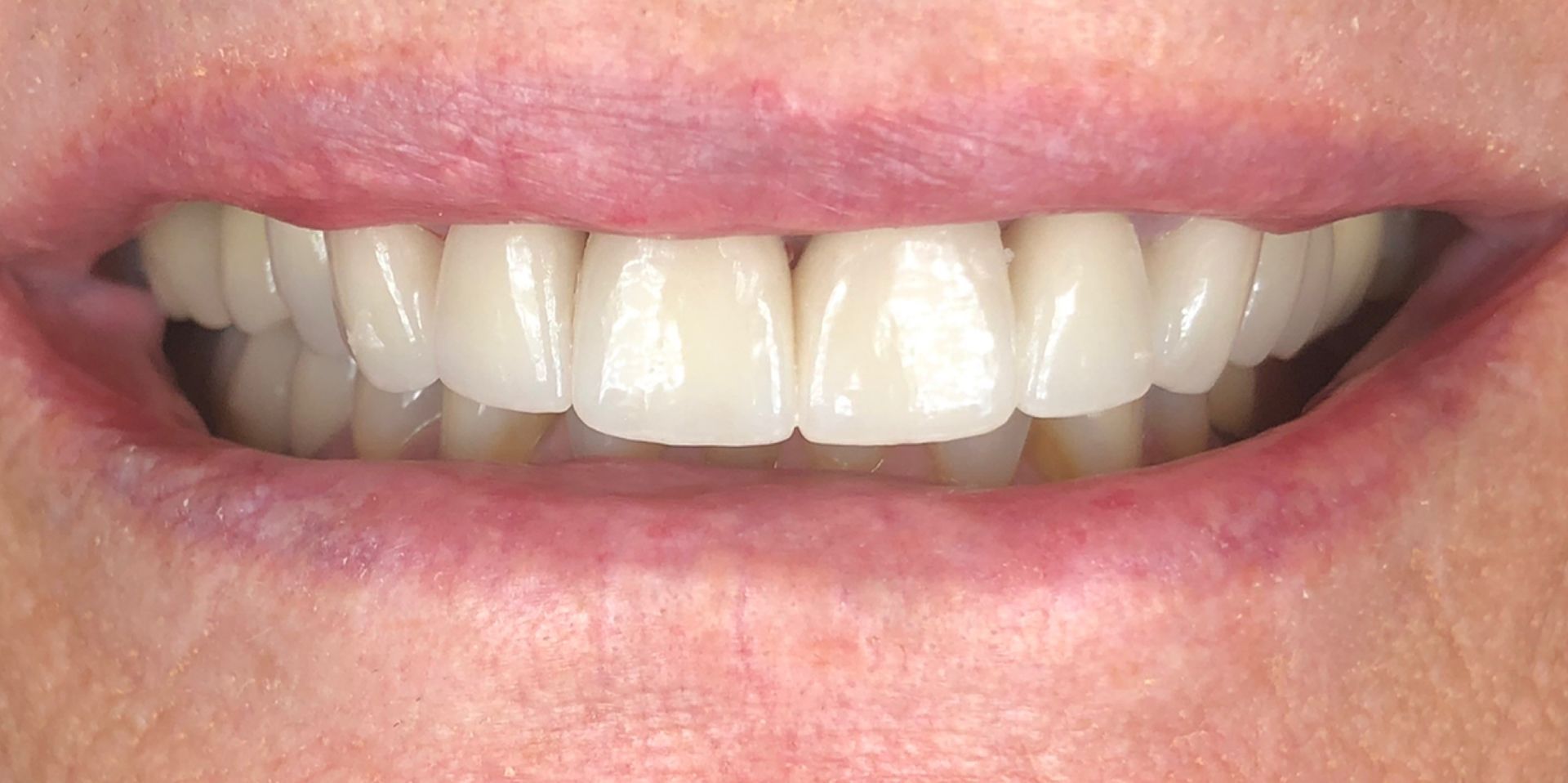 Close-up of a smiling mouth showing white teeth and pink lips