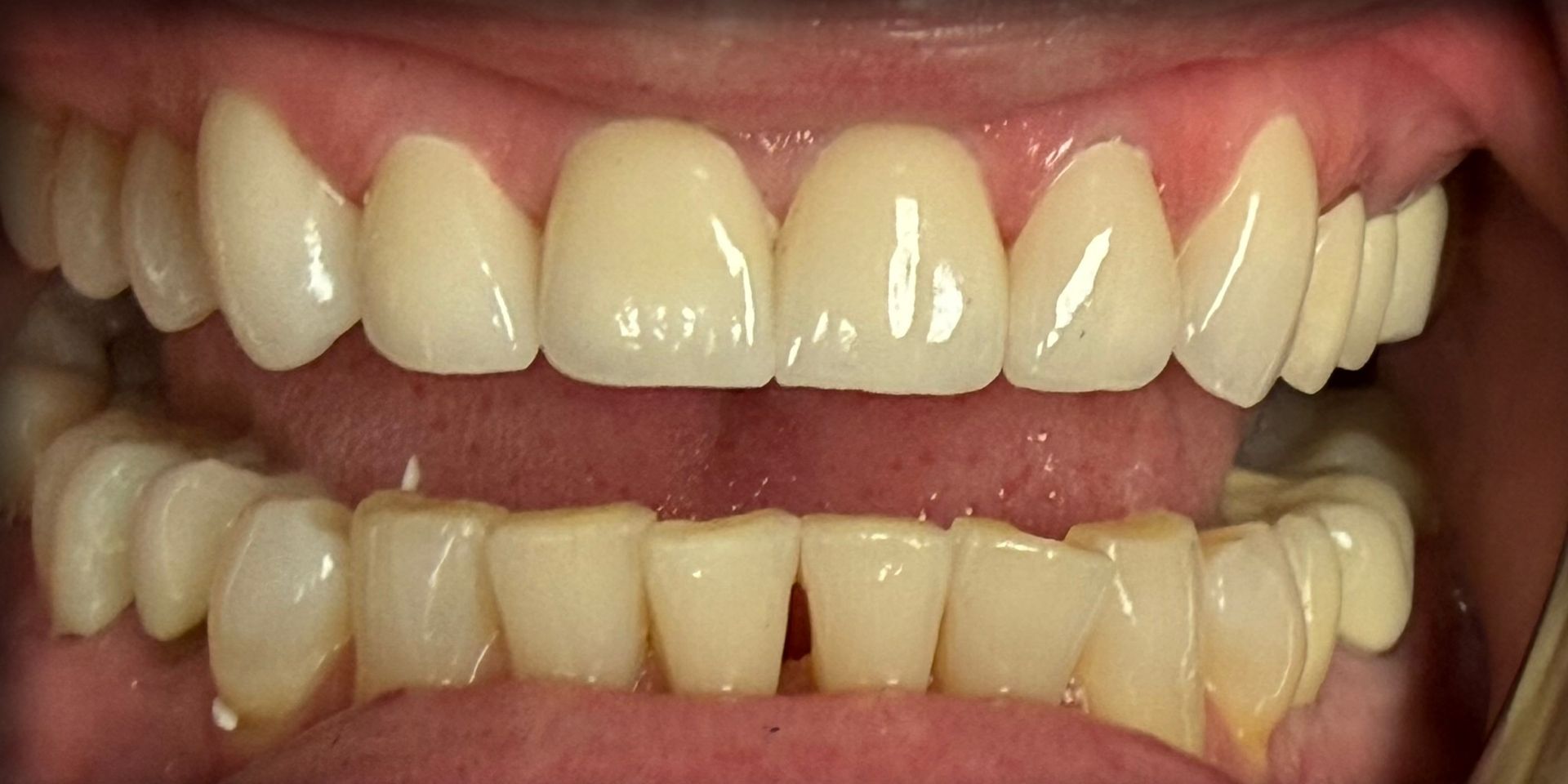 Close-up of a smiling mouth showing upper and lower teeth, with slight crowding and discoloration.