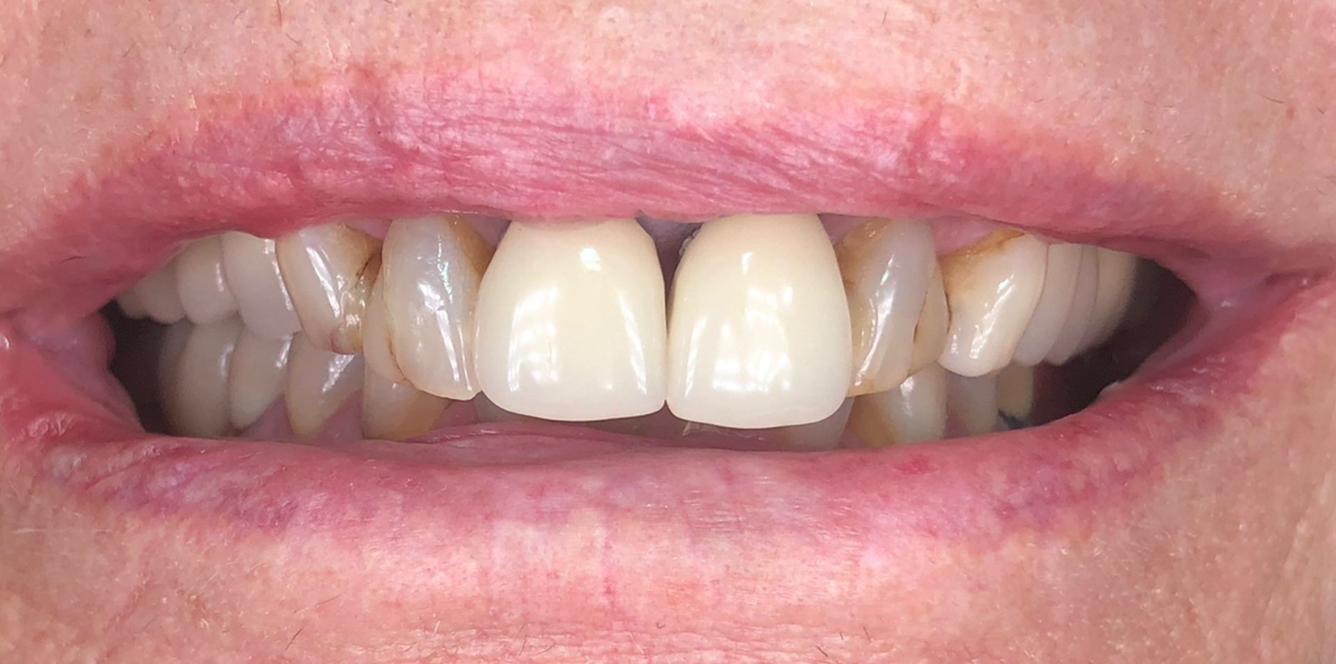 Close-up of a smiling mouth showing white upper teeth and pink lips