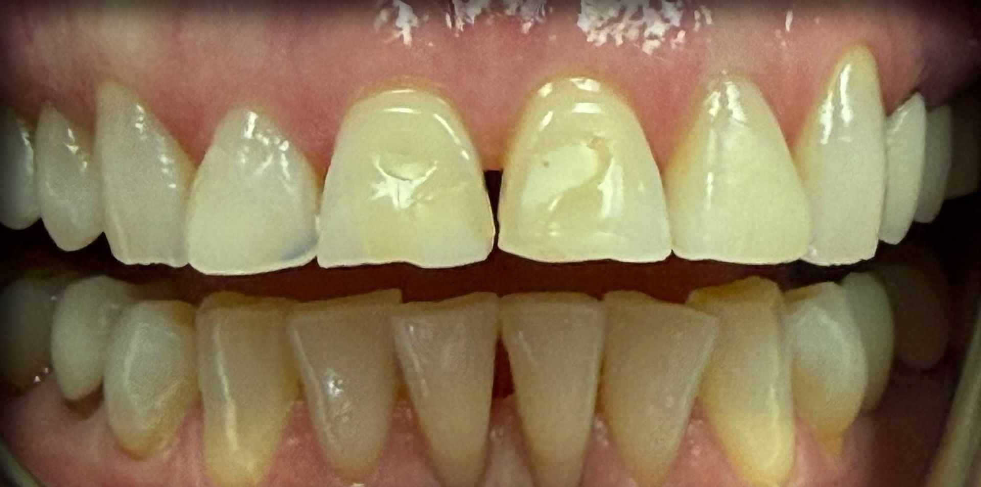 Close-up of teeth showing yellow discoloration and uneven alignment, with gums visible above and below