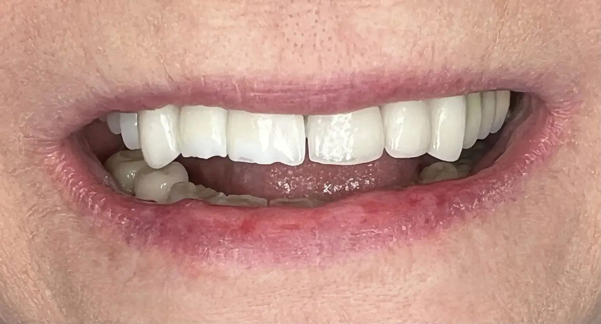 Close-up of a person's mouth showing teeth, some are white, some are off-white. The gums are reddish.