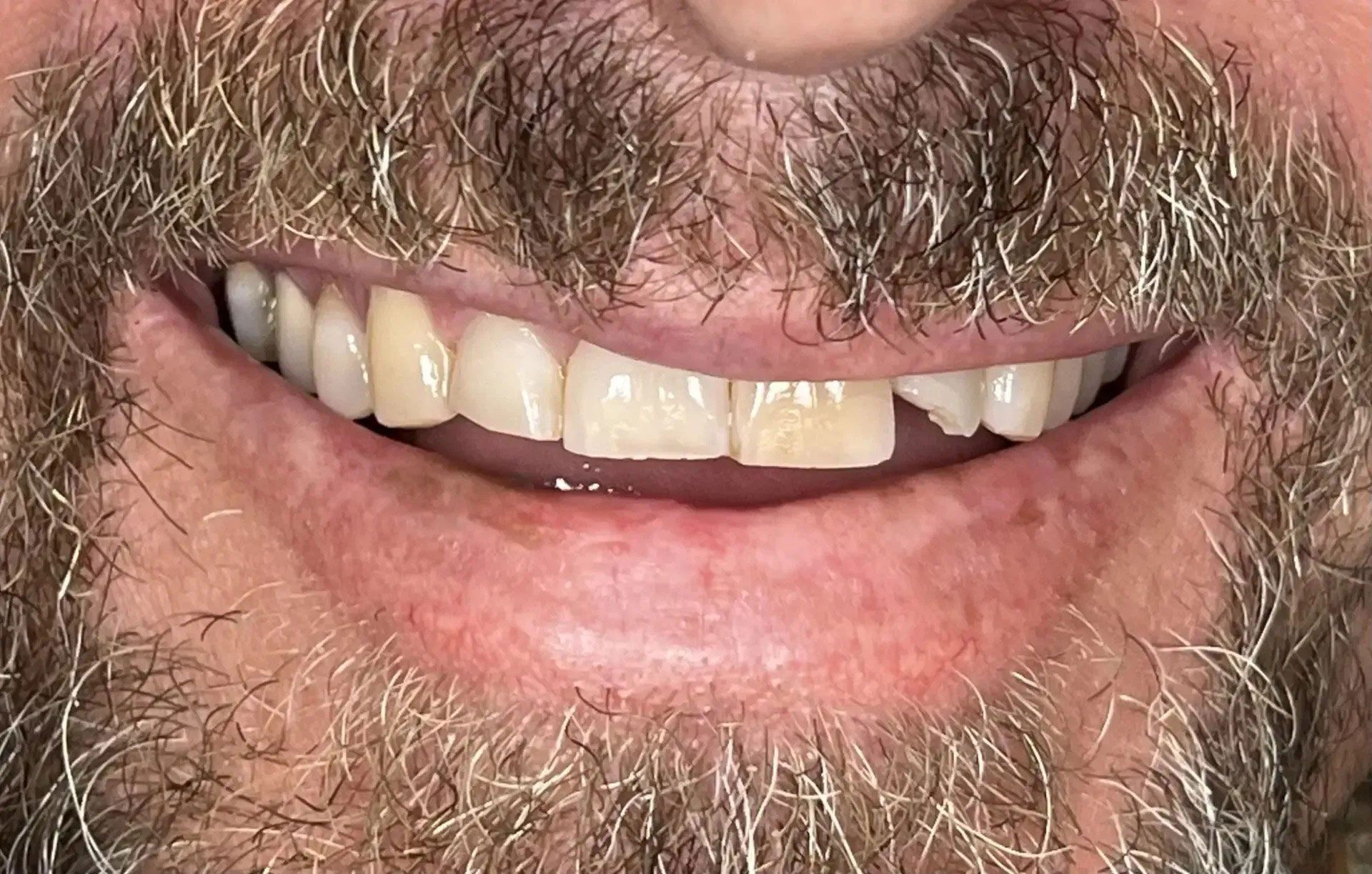 Man smiling, showing front teeth: one chipped, some yellowed. Brown beard surrounds mouth.