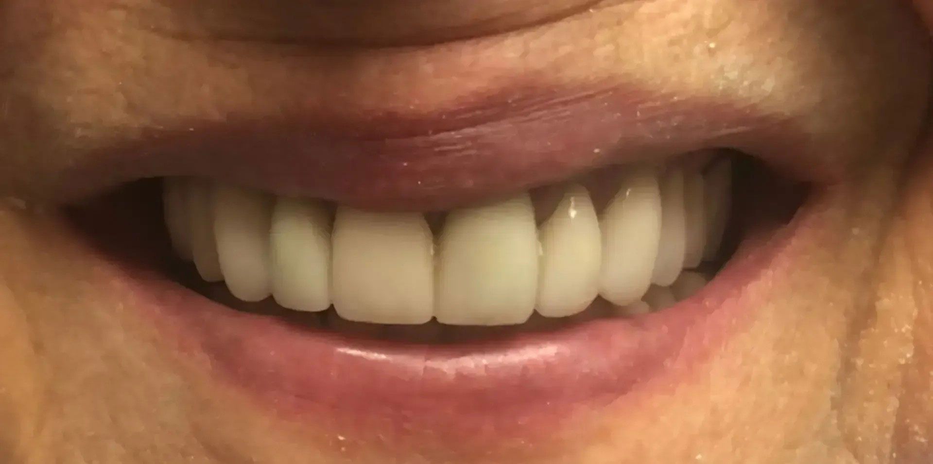 Close-up of a person's smiling mouth showing a row of white, even teeth. Pink lips surround the teeth.