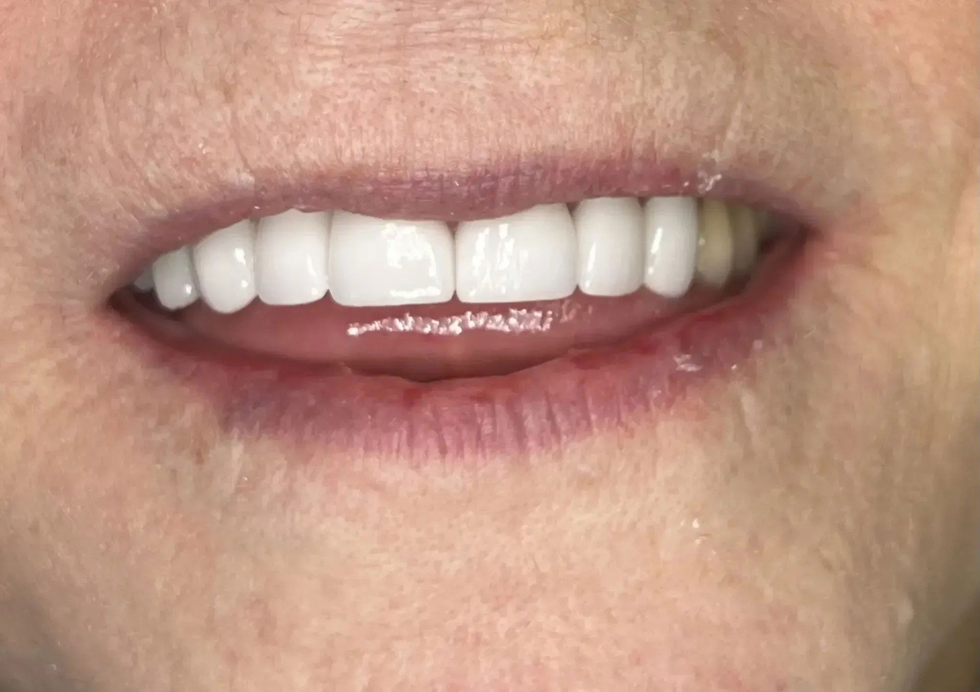 Close-up of a person's open mouth, showing bright white, evenly-spaced teeth. Pink gums and lips.