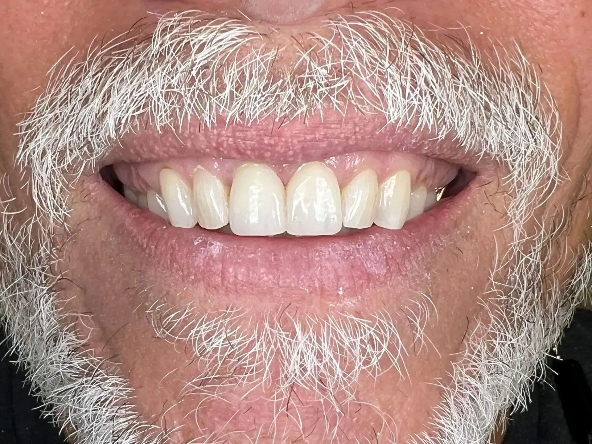 Close-up of a person's mouth with a wide smile, showing bright white teeth, pink gums, and a white beard.
