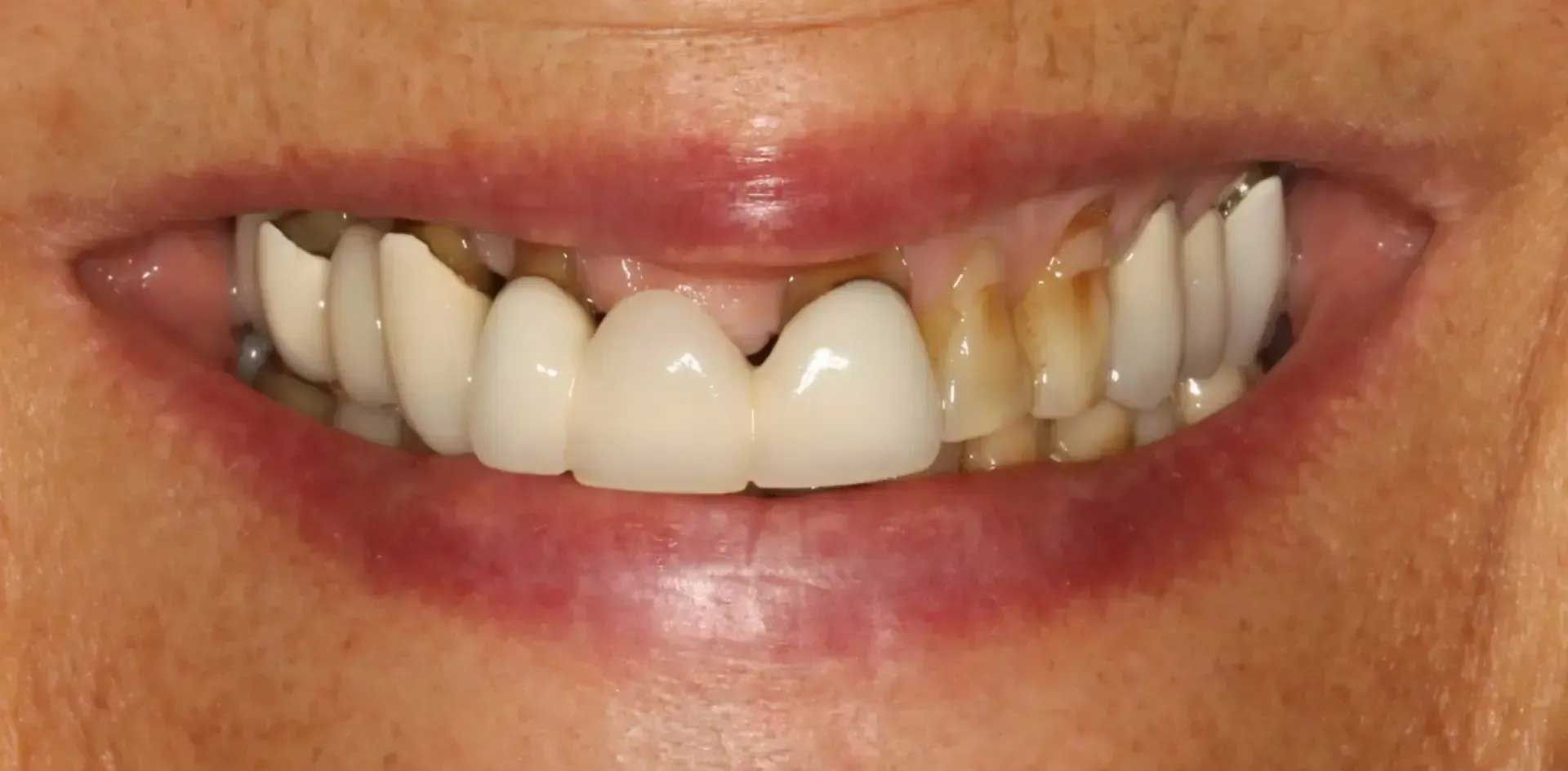 A person's smile with visible teeth, some stained and others capped; red lips and skin.