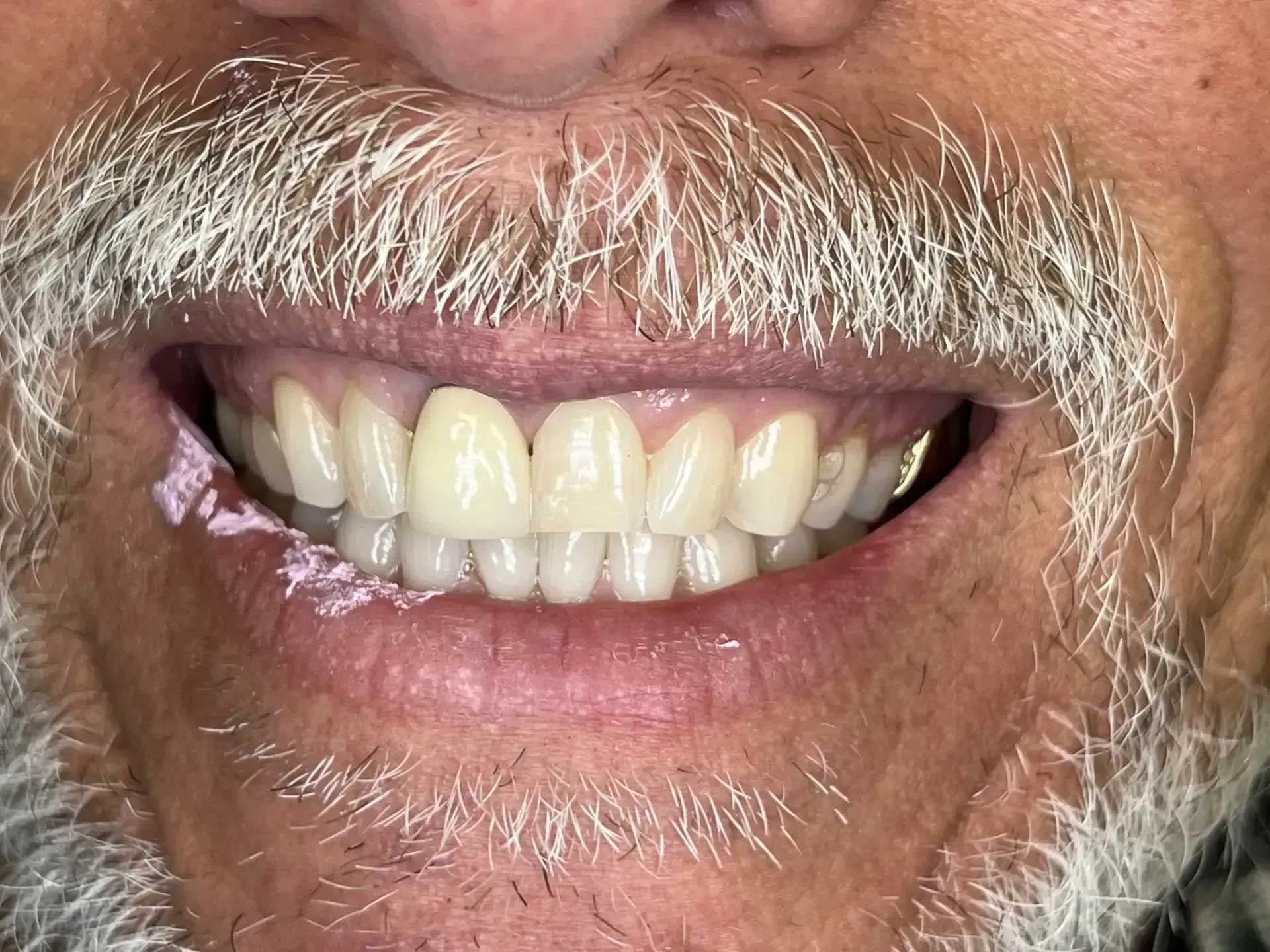 Close-up of a person smiling, showing a full set of bright white teeth. Pink substance on the lips.