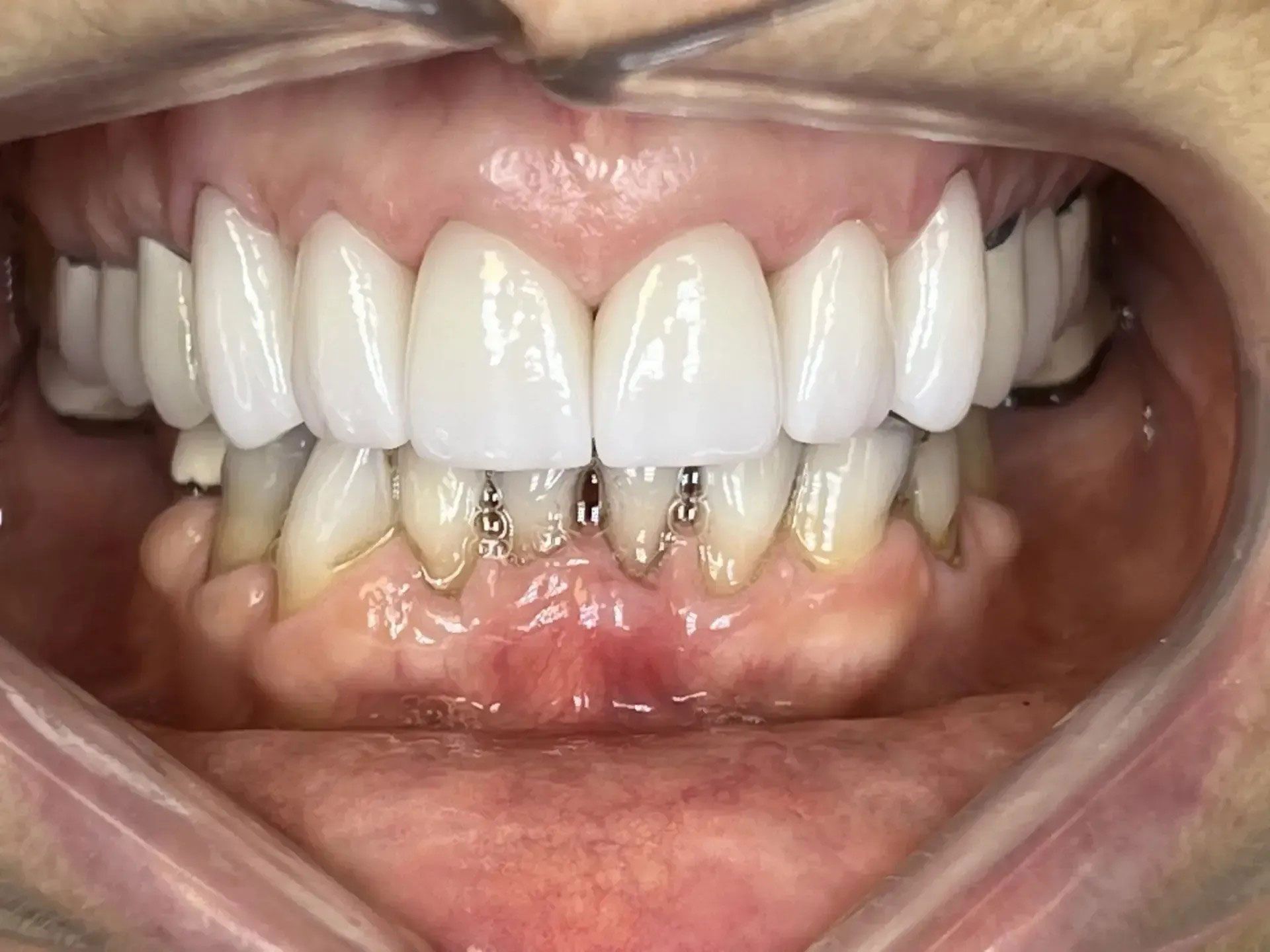 Mouth with new white dental crowns and lower teeth with metal posts. Gum line is slightly inflamed.