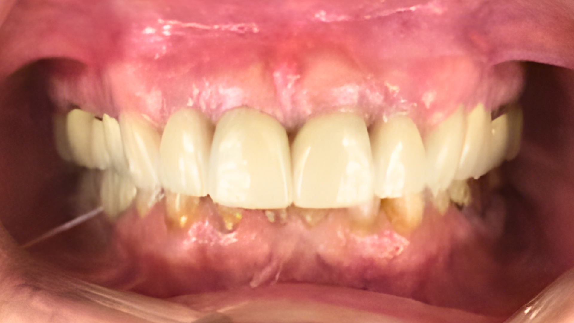 A close-up of a person's mouth showing upper teeth with dental crowns and lower natural teeth with visible plaque buildup.