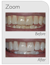 before-after teeth whitening