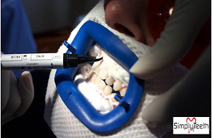 Teeth Whitening procedure