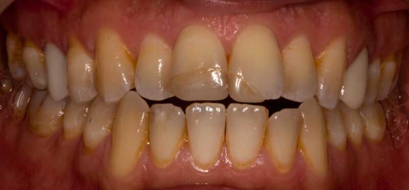 before dental procedure